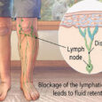 What is Lymphedema, Caused It and How is It Treated?
