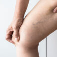 Reasons Behind Varicose Veins and The Various Treatment Options