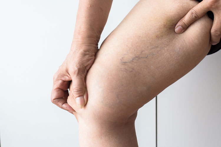 Reasons Behind Varicose Veins and The Various Treatment Options